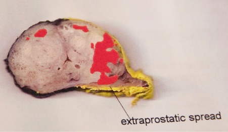 Prostate extracted with cancer shown in red
