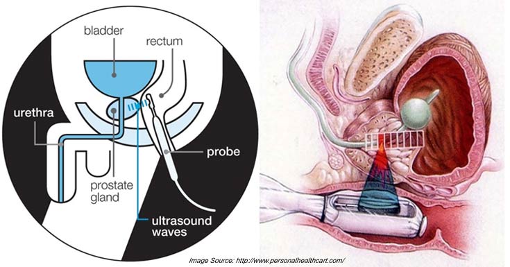 HIFU treatment diagram