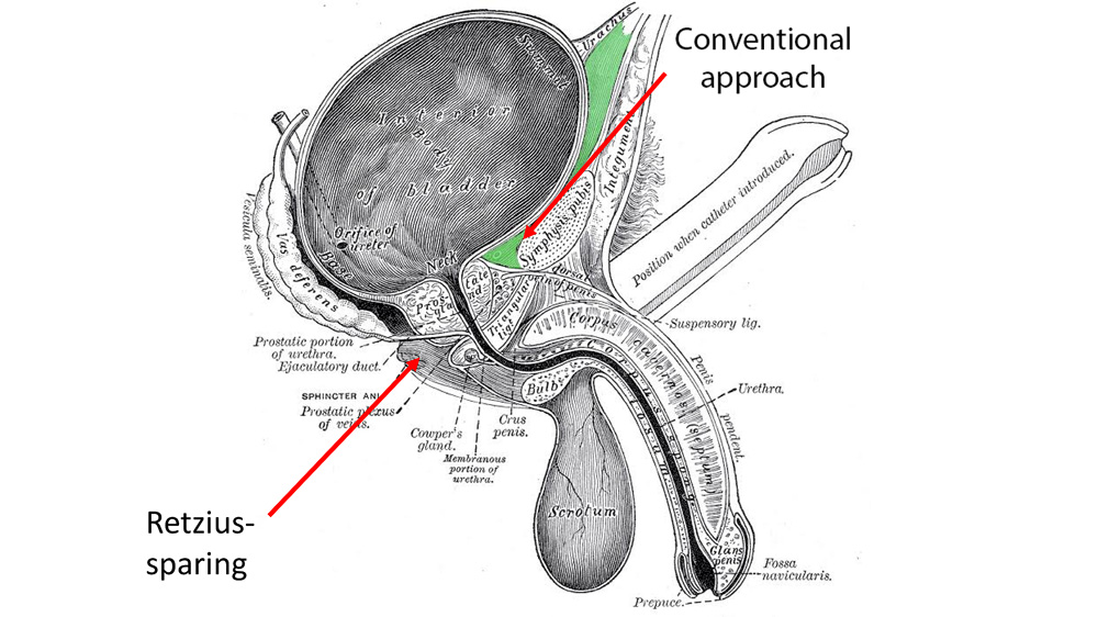 Retzius-sparing radical prostatectomy by Professor Christopher Eden