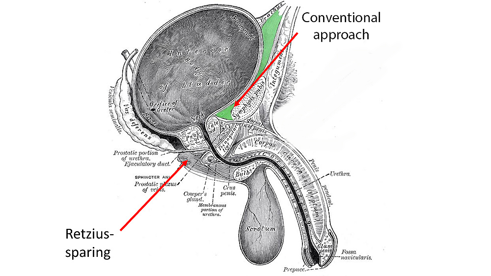 Retzius-sparing radical prostatectomy diagram by Professor Christopher Eden