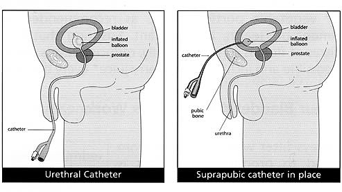 Catheters - urethral vs suprapubic