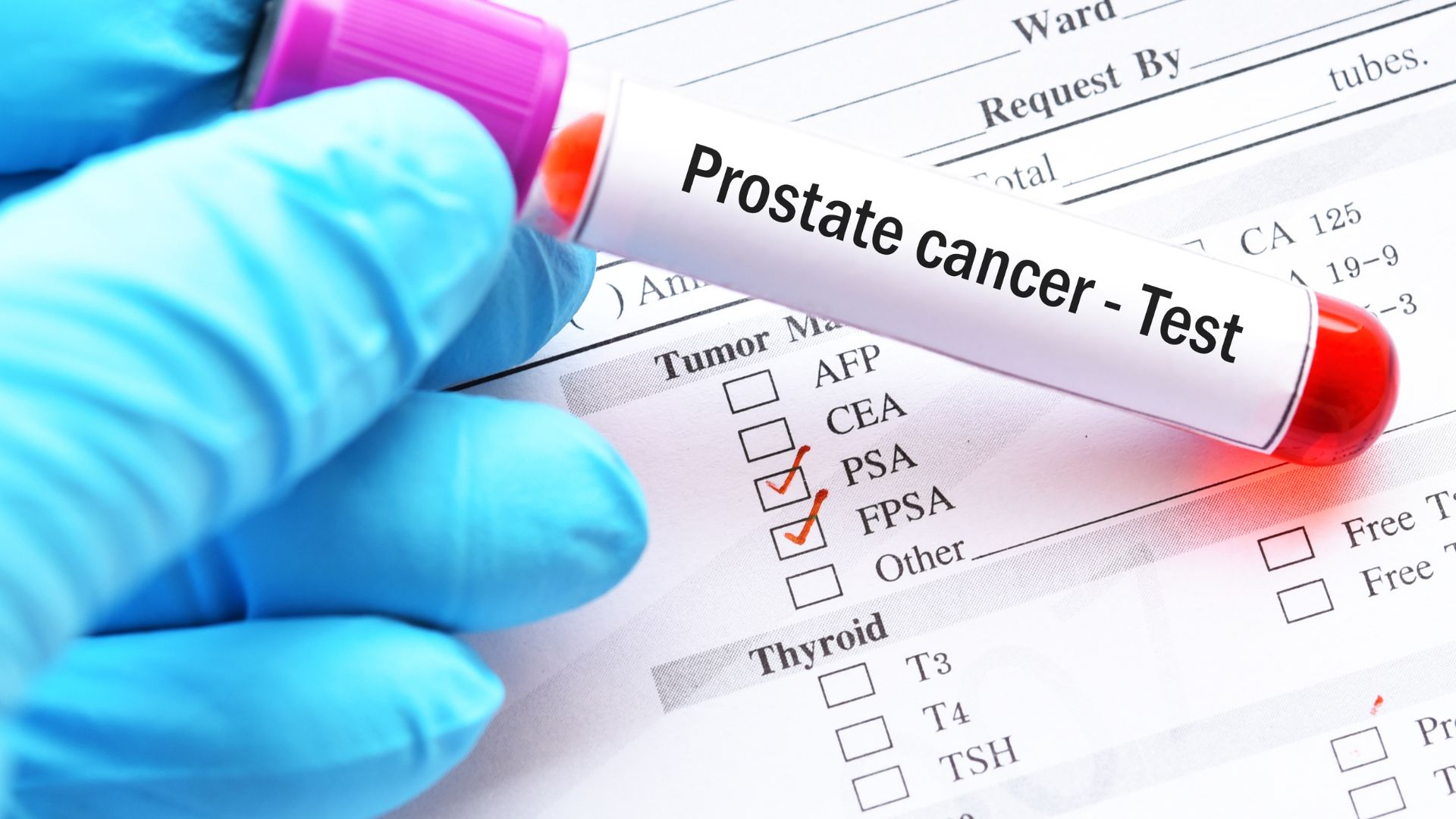 PSA Levels in Metastatic Prostate Cancer